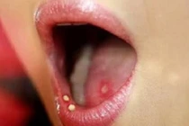 Điều trị nhiệt miệng