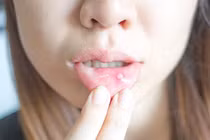 Bị nhiệt miệng kéo dài, làm sao để cải thiện?