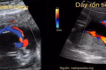 Phát hiện bệnh qua những bất thường dây rốn 