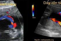 Phát hiện bệnh qua những bất thường dây rốn 