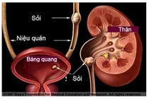 Tắc đường tiểu do uống nước lá đẩy sỏi