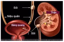 Tắc đường tiểu do uống nước lá đẩy sỏi