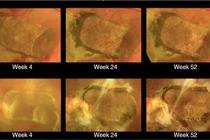 Ghép tế bào gốc vào mắt chữa mù