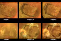 Ghép tế bào gốc vào mắt chữa mù