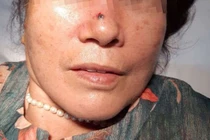  Tưởng mụn trên mũi hóa ung thư da