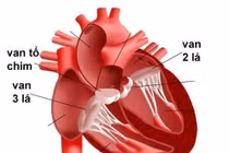 Ngại xây dựng gia đình vì mắc bệnh tim
