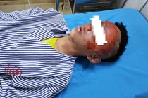 Tự chế pháo, bé trai 14 tuổi bị bỏng nặng vùng đầu mặt cổ