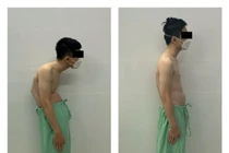 Đục xương chỉnh còng cho bệnh nhân gãy trật đốt sống