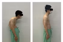 Đục xương chỉnh còng cho bệnh nhân gãy trật đốt sống