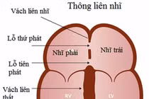 Phát hiện và điều trị thông liên nhĩ sớm