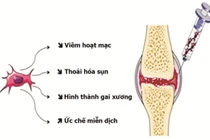 Tế bào gốc tủy xương chữa đau xương khớp