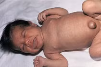 Suy giáp bẩm sinh có chữa được không?