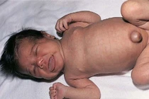 Suy giáp bẩm sinh có chữa được không?