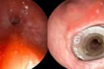 Cấp cứu bệnh nhân suy hẹp khí quản, đe dọa tính mạng