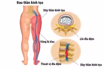 Những biến chứng nguy hiểm của hội chứng thắt lưng