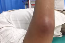 Ápxe vì đắp lá chữa mụn