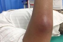 Ápxe vì đắp lá chữa mụn