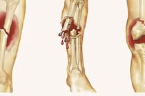 Không chủ quan với đau xương tuổi dậy thì