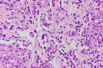 Hạn chế tiếp xúc với các vật liệu chứa amiăng