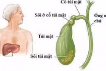 Các phương pháp điều trị sỏi mật hiệu quả