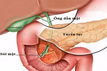 Những sai lầm trong cách ăn gây bệnh sỏi mật