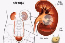 Mất thận vì chủ quan thấy sỏi không đau