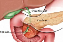 Những sai lầm trong cách ăn gây bệnh sỏi mật