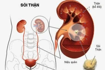 Mất thận vì chủ quan thấy sỏi không đau
