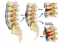 Khi nào nên phẫu thuật nhiễm trùng cốt sống?
