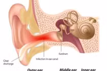 Thổi hơi khi đi máy bay tránh tắc vòi nhĩ gây viêm tai giữa