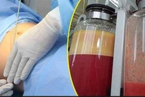 Tử vong sau 14 giờ hút mỡ bụng ở thẩm mỹ viện