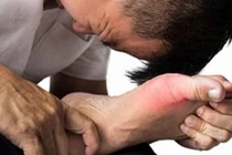 Duy trì mô cơ ở bệnh nhân gút