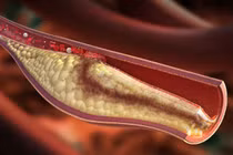 Liệu pháp đơn giản giúp giảm cholesterol