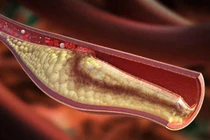 Liệu pháp đơn giản giúp giảm cholesterol