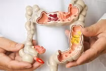 Trên 50 tuổi nên tầm soát ung thư đại trực tràng