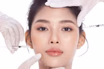 Không lạm dụng tiêm botox quá sớm 