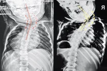 Bỏ qua thời điểm vàng can thiệp, bé 6 tuổi vẹo cột sống lệch đầu