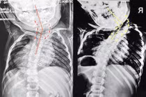 Bỏ qua thời điểm vàng can thiệp, bé 6 tuổi vẹo cột sống lệch đầu