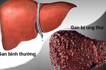 Điểm mặt tác nhân gây ung thư gan