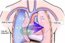Ho, đau ngực cẩn thận tràn khí màng phổi