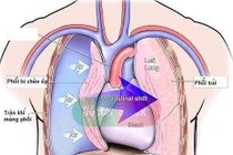 Ho, đau ngực cẩn thận tràn khí màng phổi