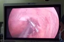 Phẫu thuật ruột thừa thấy xương cá đâm xuyên thành ruột