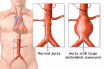 Phương pháp điều trị phình động mạch chủ bụng