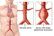 Phương pháp điều trị phình động mạch chủ bụng