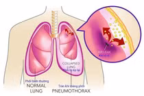 Tràn dịch màng phổi - biến chứng của nhiều bệnh