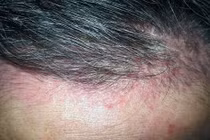 Mọc mụn do dùng keo giữ dáng tóc 