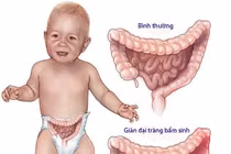 Trẻ đại tiện khó cẩn thận bệnh phình đại tràng nguy hiểm