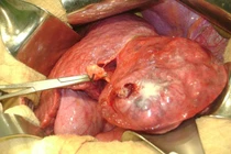  Biến chứng nguy hiểm của sỏi đường mật trong gan