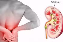 Bị đau lưng đi tiểu buốt 