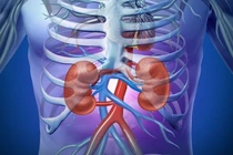 Bệnh suy thận độ 3 và cách kiểm soát bệnh từ thảo dược